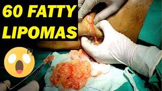 Multiple Body Lipoma Treatment !! 60 Fatty Lipomas Removal @Dezire Clinic