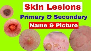 Type of skin lesions with name and picture | Primary and secondary skin lesions | skin diseases