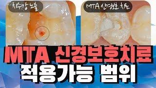 치아 신경치료 피하기! MTA 신경보호치료 적용 가능범위