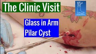 Glass Stuck in arm with a Pilar Cyst: BOGO