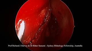 Septal Perforation Repair