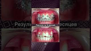 Исправление прикуса До После #допосле #braces #зубы