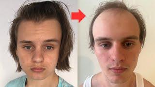 BALDING 17 to 19 Years Old