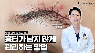 [성형외과전문의] 얼굴 흉터 남지 않게 관리하는 법ㅣ흉터관리에 대한 오해ㅣ 켈로이드와 비후성반흔의 경우