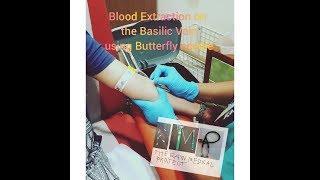 Blood extraction on the basilic vein using butterfly needle