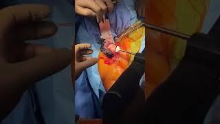 Shoulder Replacement Live Surgery Video Dr Manit Arora