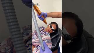 Pico Laser by Dr Rizwan Malik | MR Aesthetics Lahore | Dr Rizwan Malik | #youtubeshorts  #trending