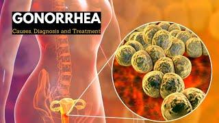 Gonorrhea, Causes, Signs and Symptoms, Diagnosis and Treatment.