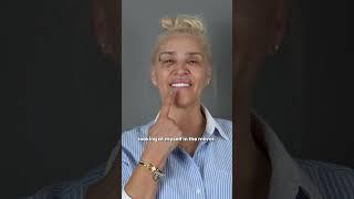 See the difference of a Hollywood smile through before-and-after comparisons!