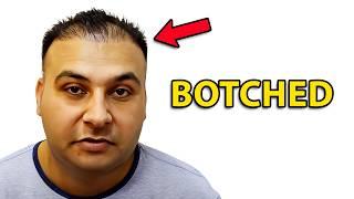 BOTCHED Hair Transplant Results | Hair Surgeon Reacts