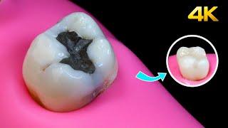 AMAZING Amalgam Filling Replacement!