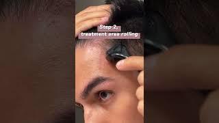 How to use derma roller at home? | 3 steps to teach you how to treat hair loss at home #mesotherapy