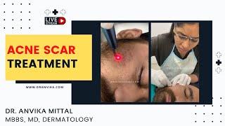 Acne Scar Removal | Acne Scar Treatment by Dermatologist : Dr. Anvika MBBS, MD (Dermatology)