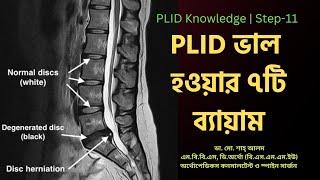 PLID 11 | PLID ভাল হওয়ার ৭টি ব্যায়াম  | 7 PLID Exercises | Doctor Shah Alam