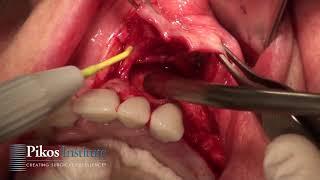 Maxillary Ridge Split - Pikos Institute