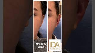 연예인들께서 정말 좋아하시는 필러가 어떤 필러인지 아시나요?