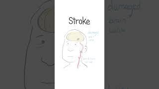 Strokes Explained #healthsketch #shorts