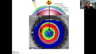 Orthokeratology: Troubleshooting Patient Cases