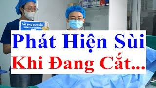 Hiếm Gặp: Phẫu Thuật Cắt Hẹp Bao Quy Đầu Phát Hiện Ra Sùi Mào Gà Rất Nặng - Trực Tiếp Bs Sắc Xử Lý!