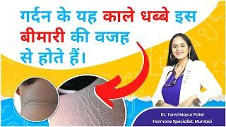 गर्दन के काले धब्बे ( ACANTHOSIS NIGRICANS) की बीमारी by Dr Tanvi Mayur Patel