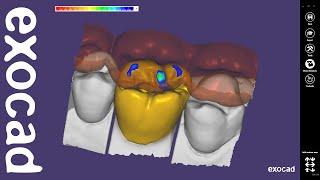 exocad Video Tutorial: Basic Features  / Anatomic Coping with Cutback