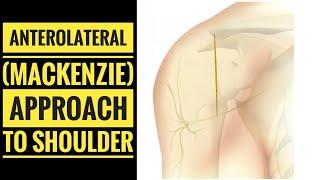 Anterolateral Approach to Shoulder (McKenzie Approach)