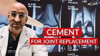 Cement Use for Knee Replacement Surgery