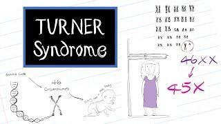 What is Turner Syndrome? (HealthSketch)