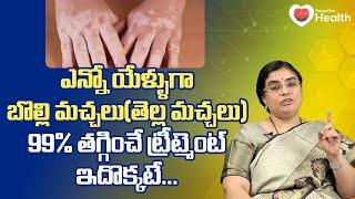 Vitiligo | ఎన్నో యేళ్ళుగా బొల్లి 99% తగ్గించే ట్రీట్మెంట్..! Unani Dr. SGV Sathya | TeluguOne Health