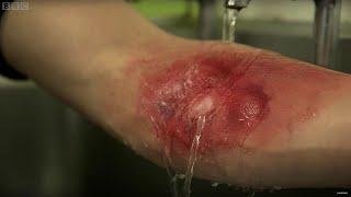 How You Should Treat A Serious Burn | Earth Science