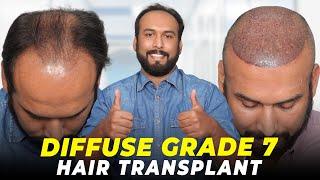 Hair Transplant in Ahmedabad | Best Results & Cost of Hair Transplant in Ahmedabad