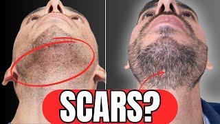 Beard Hair Transplants -The TRUTH!