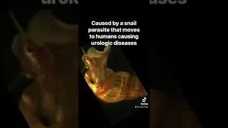 Schistosomiasis 