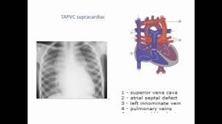 Total and Partial Anomalous Pulmonary Venous conne