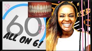 All on 6 dental Implants: 60 Seconds Dental Answers with Dr. Denis the Dentist