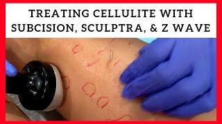 Treating Cellulite with Subcision, Sculptra, & Z Wave