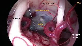 Endoscopic View HF Spasm - Spasme hémifacial - vue endoscopique