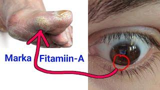 Fitamin-A marka jirkaada ku yaraado waxaa la kulmi kartaa dhibaatooyinkaan iyo Calaamadahaan