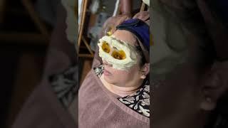 Ayurveda Treatment for Eyes  NETRA TARPANA