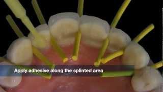 Dentapreg Oral Splint