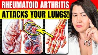 The Scary Link Between Rheumatoid Arthritis and Lung Damage!