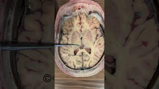Basal Ganglia