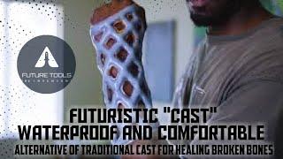 futuristic cast | waterproof cast | alternative of traditional cast for healing broken bones