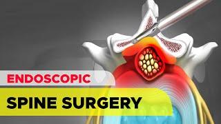 Endoscopic Spine Surgery: The Unilateral Biportal Endoscopic (UBE) Technique