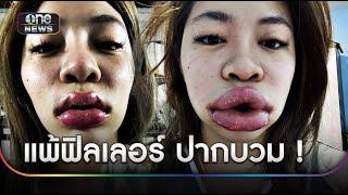 สาวแชร์อุทาหรณ์ แพ้ฟิลเลอร์อย่างหนักทำปากบวม  | ข่าวเที่ยงช่องวัน | สำนักข่าววันนิวส์