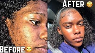 SKIN | How To Get Rid Of Hyperpigmentation (Dark spots) less than a month | FAST!!!