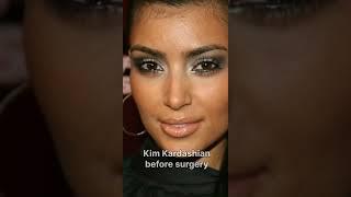 kim Kardashian before surgery and after #kimkardashian #beforeandafter #surgery