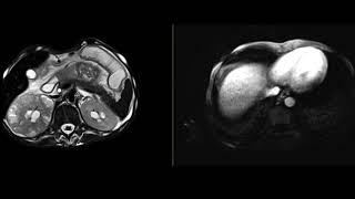 Pyelonephritis with renal abscesses