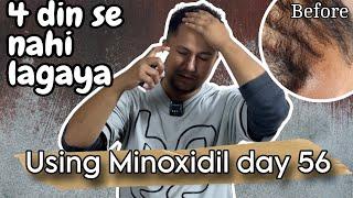 Day 56 Update  Left Minoxidil for 5 days  cause HAIRFALL #hairgrowthjourney #minoxidilsideeffects