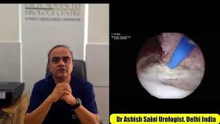 EBRT  Enbloc  bladder tumour removal by Thulium fiber laser by Dr Ashish Saini